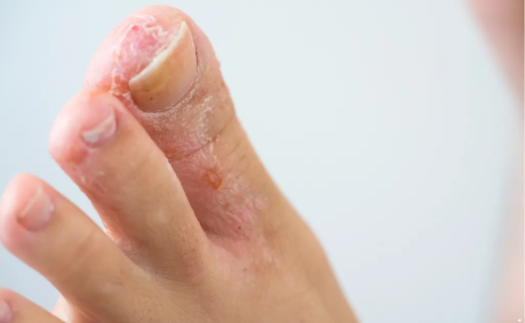 Emergency Room For Athlete’s Foot In Houston, TX