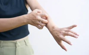 Close-up of hands showing symptoms of an itchy skin condition.